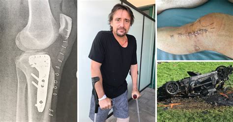 richard hammond head injuries.